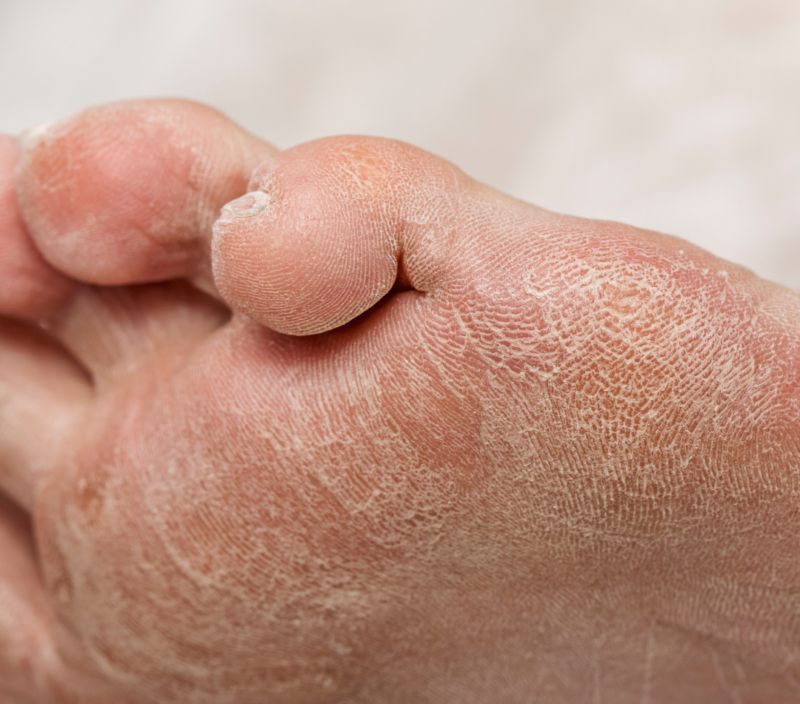 Il piede diabetico prevenzione e cura